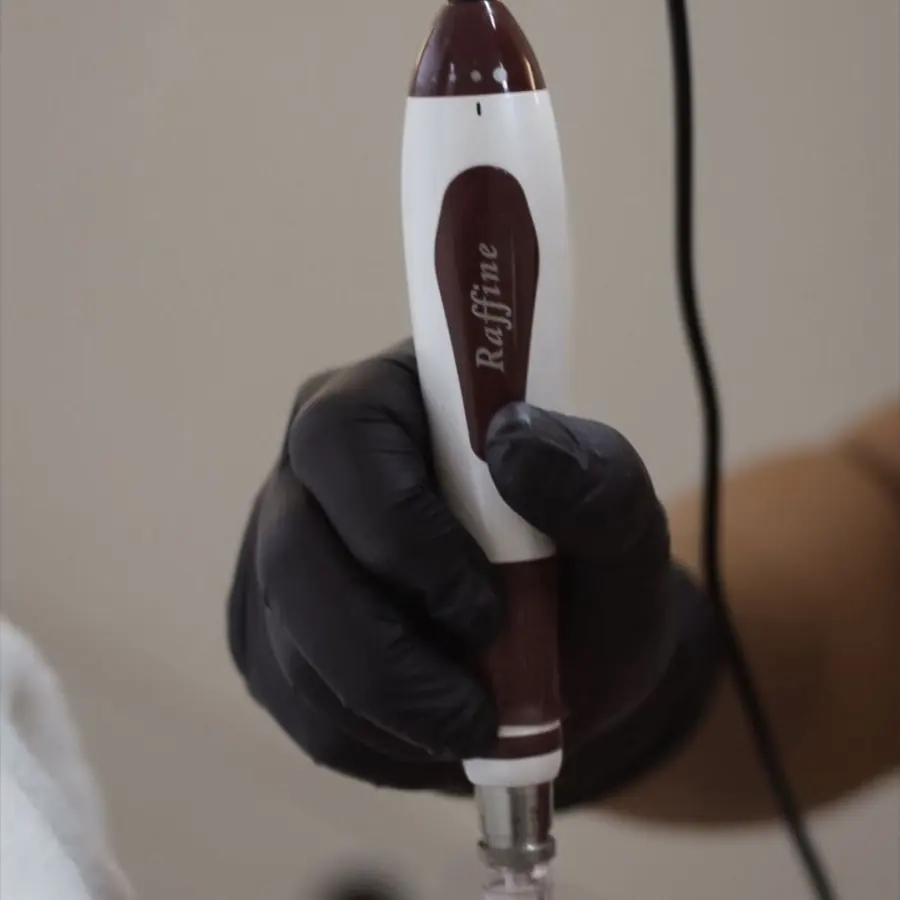 Microneedling at Radiance by Charlotte