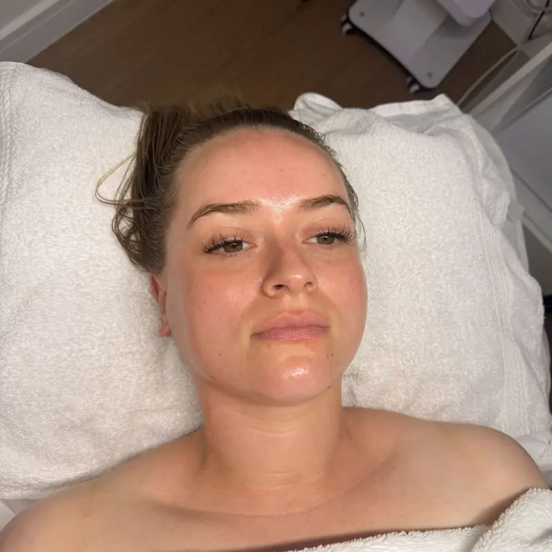 Client skin after treatment at Radiance by Charlotte