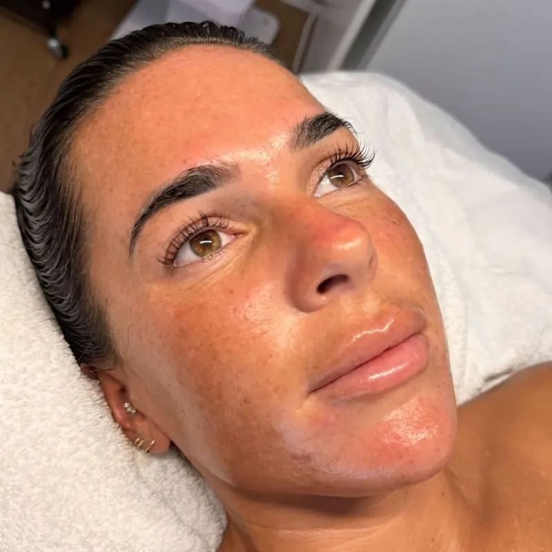 Client skin after treatment at Radiance by Charlotte