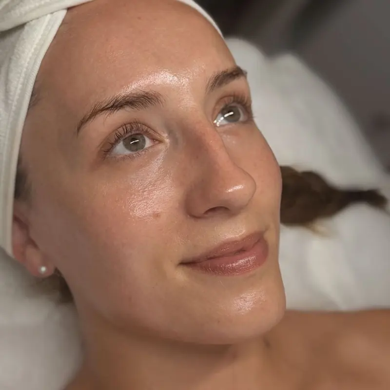 Client skin after treatment at Radiance by Charlotte
