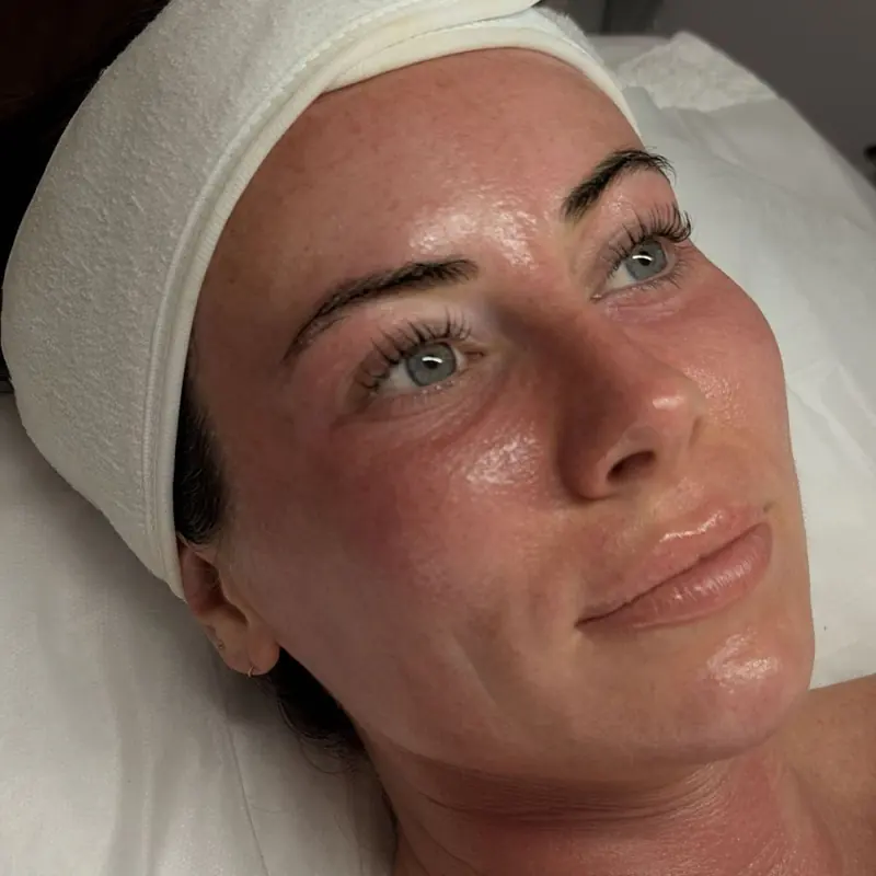 Client skin after treatment at Radiance by Charlotte
